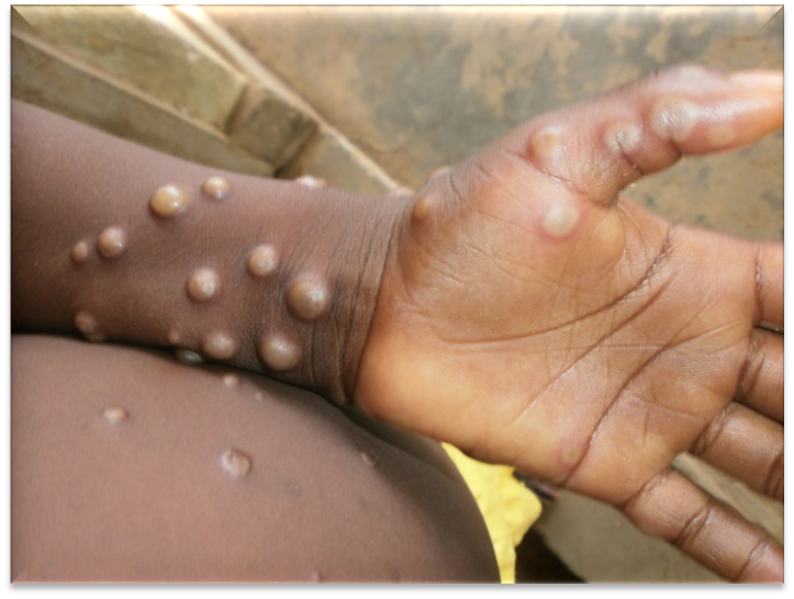 Ghana Records 7 More Mpox Cases; Total Now 170
