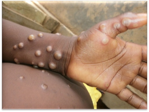Ghana Records First Mpox Fatality as Total Cases Reach 257